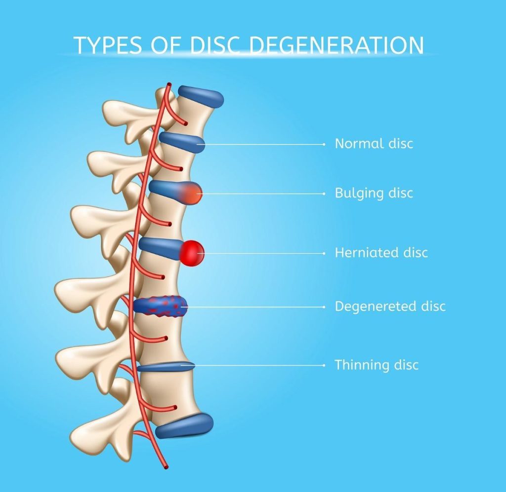 What Do They Do For A Bulging Disc at Cathy Donaldson blog